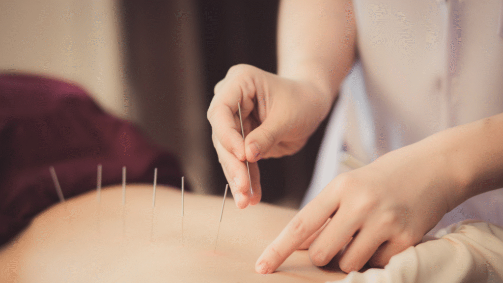 Close-up image of acupuncture treatment, showing a practitioner's hands inserting needles into a patient's back for therapeutic relief.